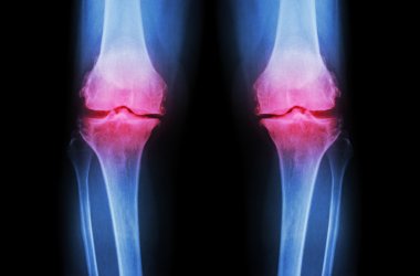 Osteoarthritis Knee ( OA Knee ). Film x-ray both knee ( front view ) show narrow joint space ( joint cartilage loss ) , osteophyte , subchondral sclerosis clipart