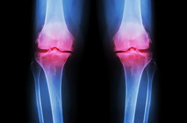 Rodilla de osteoartritis (rodilla OA). La radiografía de ambas rodillas (vista frontal) muestra un espacio articular estrecho (pérdida del cartílago articular), osteófita, esclerosis subcondral — Foto de Stock