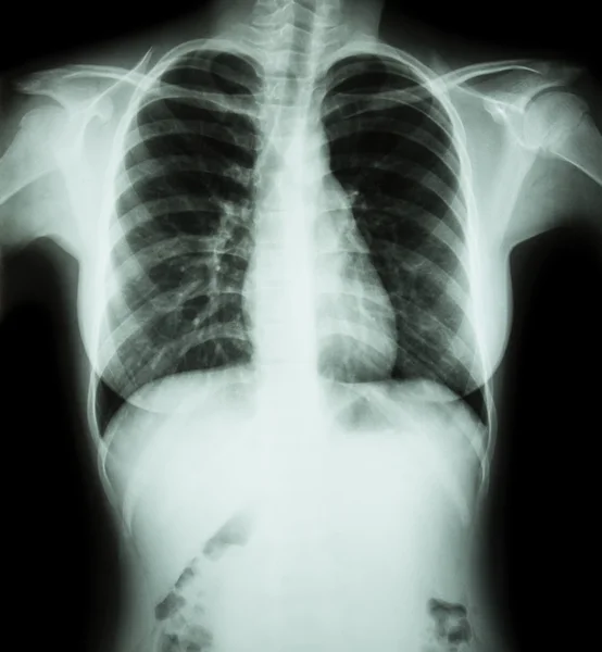 Ακτινογραφία θώρακος φιλμ: Εμφάνιση κανονική στο στήθος της γυναίκας — Φωτογραφία Αρχείου