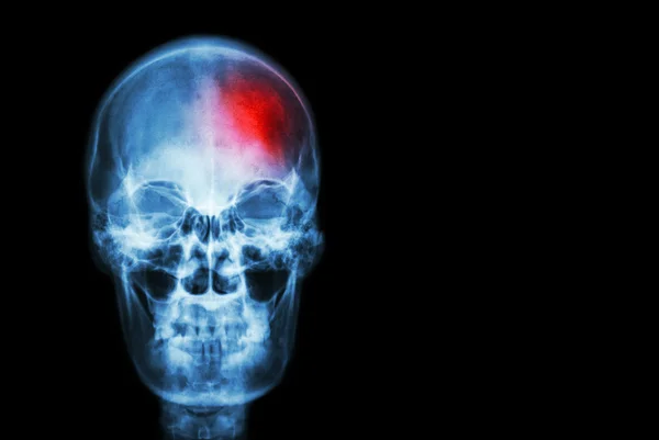 Acidente vascular cerebral (acidente vascular cerebral). filme crânio de raios-x de humano com área vermelha (médica, ciência e cuidados de saúde conceito e fundo  ) — Fotografia de Stock