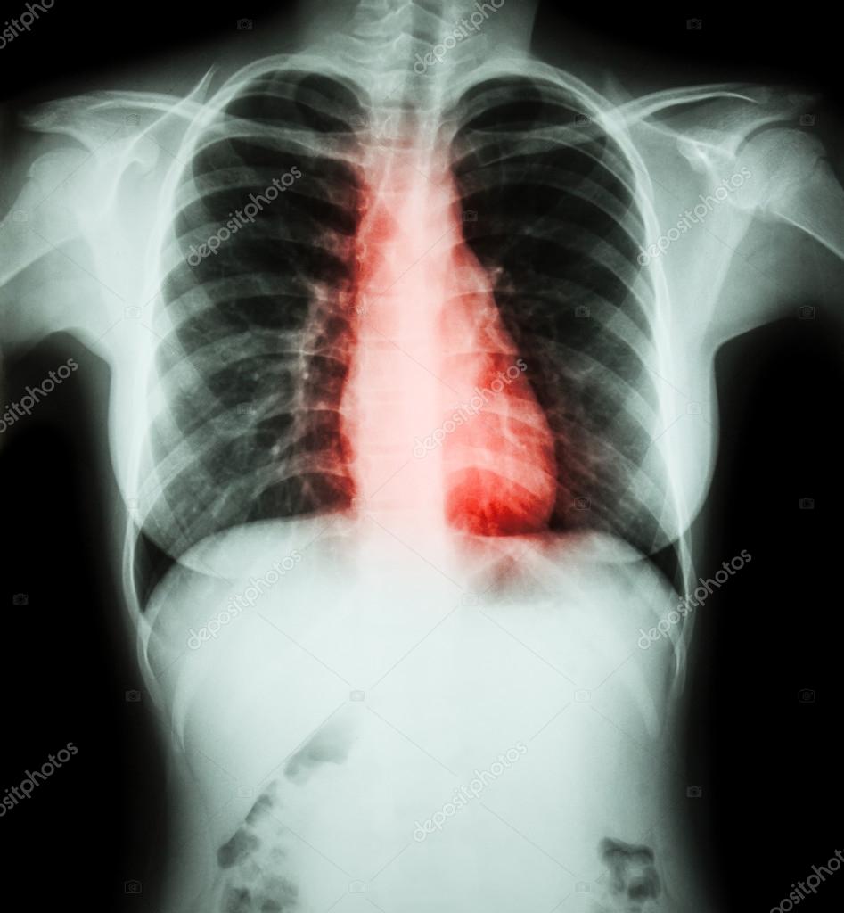 Heart disease ( Film chest xray of woman with heart disease ) — Stock
