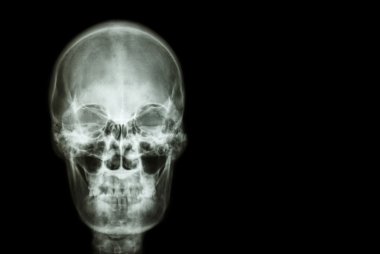 film x-ray skull of human and blank area at right side ( Medical , Science and Healthcare concept and background ) clipart