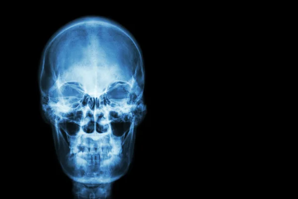 Film x-ray czaszki ludzkiego i pustego obszaru po prawej stronie (medycyna, nauka i opieka zdrowotna koncepcja i tło ) — Zdjęcie stockowe