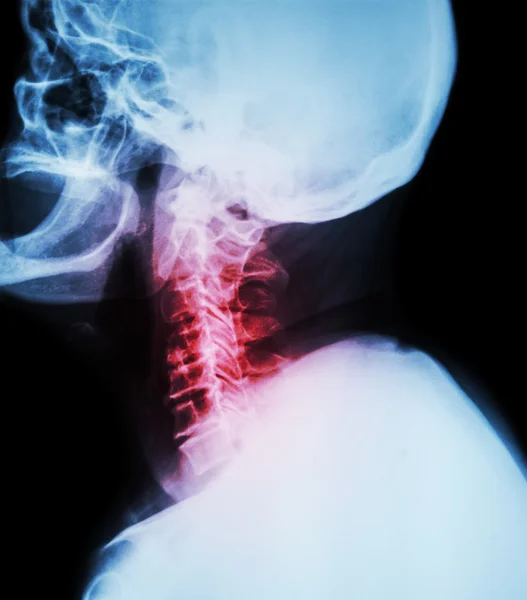 Espondilosis cervical. Radiografía fílmica de columna cervical (posición lateral) (vista lateral)  ) — Foto de Stock