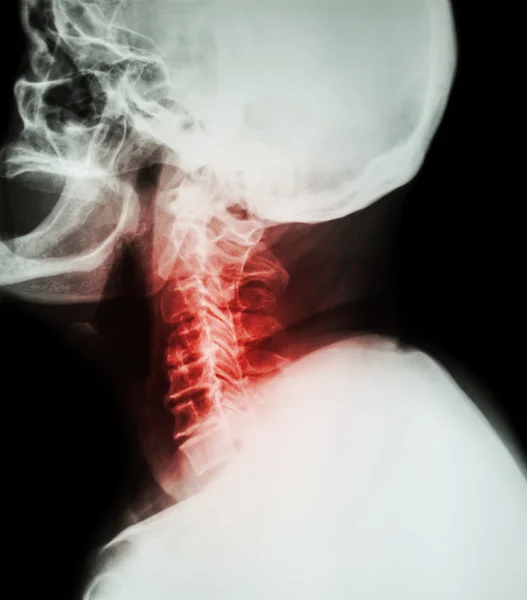 Espondilosis cervical. Radiografía fílmica de columna cervical (posición lateral) (vista lateral)  ) — Foto de Stock