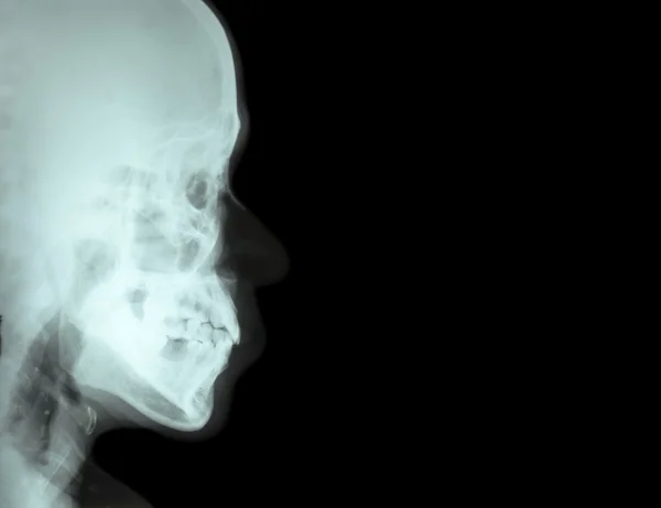 Film X-ray laterale neusbeen (zijaanzicht van schedel) en leeg gebied aan rechterkant — Stockfoto