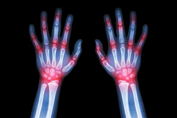 Reumatoidalne zapalenie stawów, DNA moczowa (film x-ray obu rąk dziecka z wielu stawów) (medycyna, nauka i koncepcja opieki zdrowotnej ) — Zdjęcie stockowe