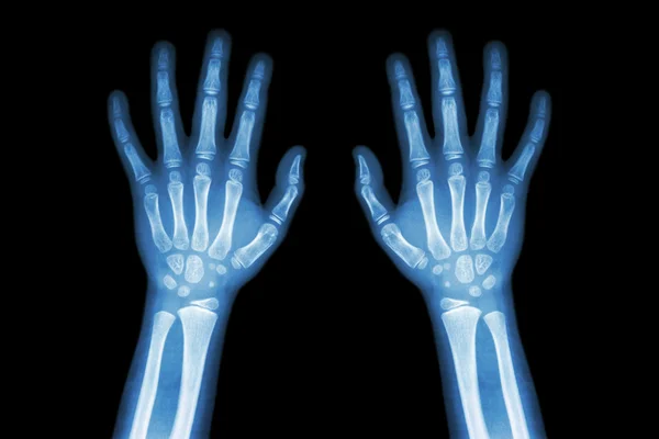 Normalny X-ray film obie ręce dziecka — Zdjęcie stockowe