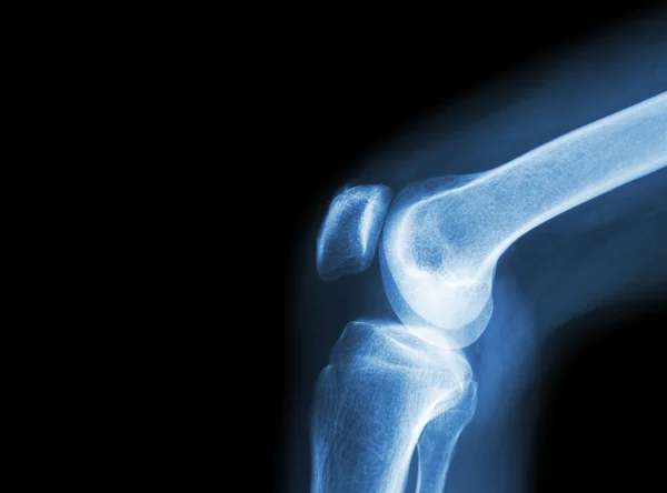 Film x-ray kniegewricht met artritis (jicht, reumatoïde artritis, septische artritis, osteoartritis knie) en leeg gebied op de linker kant — Stockfoto