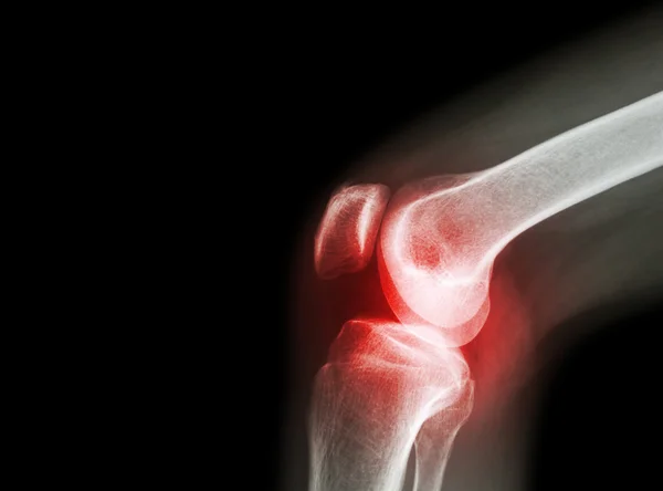 Film röntgen knäleden med artrit (gikt, reumatoid artrit, septisk artrit, artros knä) och tomt område till vänster — Stockfoto