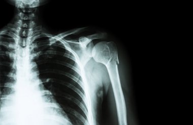 Humerus (kol kemiği) boynunda kırık ( film x-ray sol omuz ve sağ tarafta boş alan )