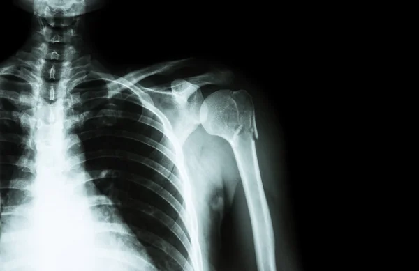 Fracture at neck of humerus ( arm bone ) ( film x-ray left shoulder and blank area at right side ) — Stock Photo, Image