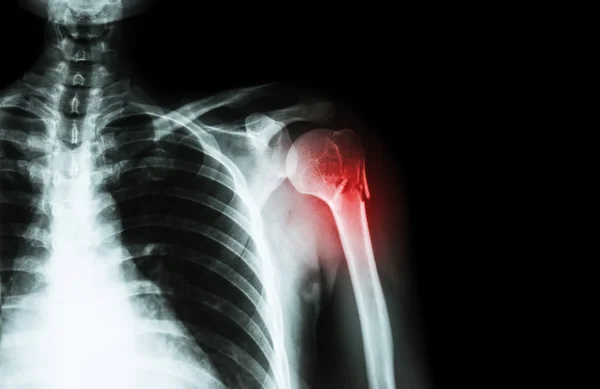 Fracture at neck of humerus ( arm bone ) ( film x-ray left shoulder and blank area at right side ) — Stock Photo, Image