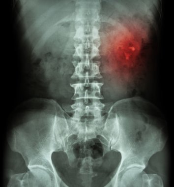 Böbrek taşı ( böbrek taşı , renal kalkülüs ) ( film x-ray Kub ( Böbrek - Üreter - Mesane ) sol böbrek taşı göstermek )