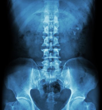 Böbrek taşı ( böbrek taşı , renal kalkülüs ) ( film x-ray Kub ( Böbrek - Üreter - Mesane ) sol böbrek taşı göstermek )
