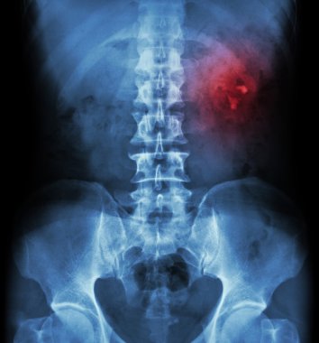 Böbrek taşı ( böbrek taşı , renal kalkülüs ) ( film x-ray Kub ( Böbrek - Üreter - Mesane ) sol böbrek taşı göstermek )