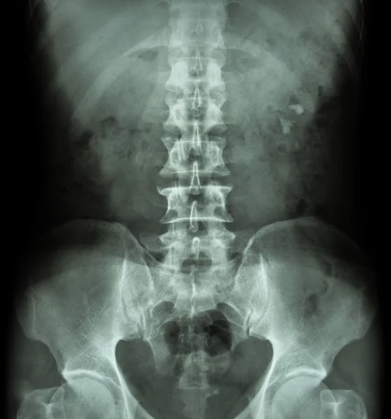 Kidney stone ( renal stone , renal calculi ) ( film x-ray KUB ( Kidney - Ureter - Bladder ) show left renal stone ) — Stock Photo, Image