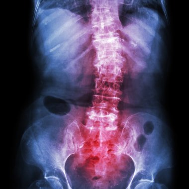 Spondylosis and Scoliosis ( film x-ray lumbar - sacrum spine show crooked spine ) ( old patient ) ( Spine Healthcare ) clipart