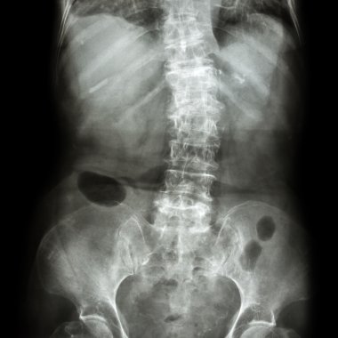 Spondilosis ve Skolyoz ( film x-ray lomber - sakrum omurga göstermek çarpık omurga ) ( yaşlı hasta ) ( Omurga Sağlık )