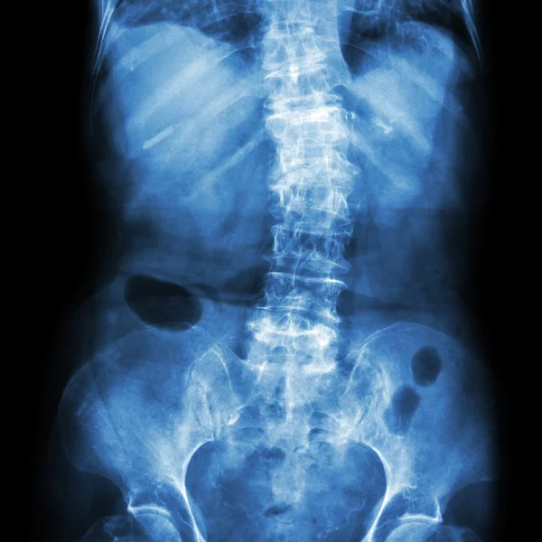 Espondilosis y escoliosis (radiografía de la película lumbar sacro columna vertebral muestran la columna torcida) (paciente de edad) (Spine Healthcare  ) —  Fotos de Stock