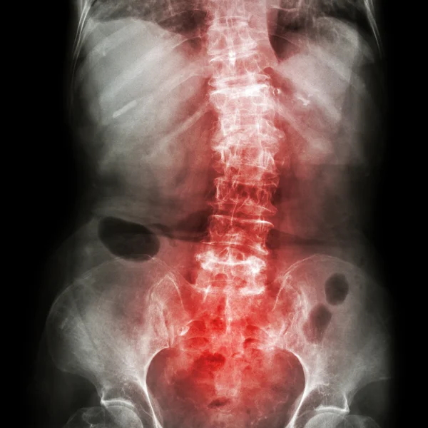 Spondylose und Skoliose (Film-Röntgen-Lendenwirbelsäule - Kreuzwirbelsäule zeigen schiefe Wirbelsäule) (alter Patient) (Wirbelsäulengesundheit ) — Stockfoto