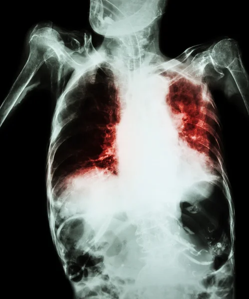 Tuberculosis pulmonar con insuficiencia respiratoria aguda (radiografía de tórax de pacientes de edad avanzada que muestra infiltración alveolar e intersticial tanto pulmonar con tubo endotraqueal) debido a la tuberculosis micobacteriana — Foto de Stock