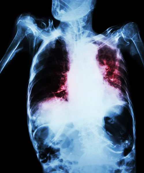 急性呼吸不全、肺結核 (古い患者の胸部 x 線フィルムを示す肺胞、間質浸潤両方肺気管内チューブ) 結核のため — ストック写真