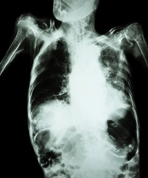 Plicní tuberkulóza s akutní respirační selhání (Film rentgenový snímek ze starých pacientů ukazují alveolární a intersticiální infiltrace obou plic s endotracheální trubice) způsobené bakterií mycobacterium tuberkulóza — Stock fotografie