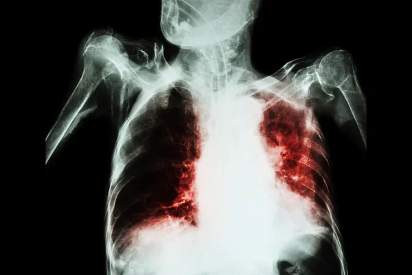 肺结核合并急性呼吸衰竭 (老年患者的胸部 x 光胶片显示肺泡和间质浸润两肺与气管插管) 由于结核分枝杆菌 — 图库照片