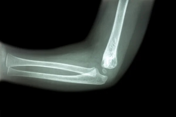 Film x-ray of child 's elbow ( normal child 's elbow ) ( Side view , Lateral ) — Stock Photo, Image