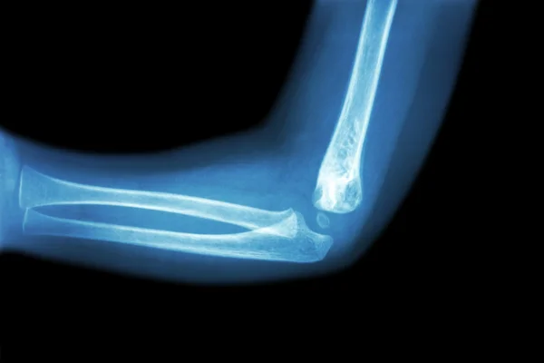 儿童肘部（正常儿童肘部）的胶片 X 射线（侧面视图、侧视图） ) — 图库照片