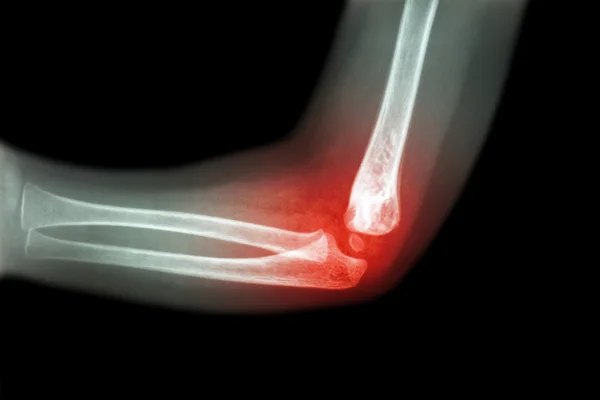 Rheumatoid arthritis , Gouty arthritis ( film x-ray child 's elbow with arthritis at elbow ) ( Side view , Lateral ) — Stock Photo, Image