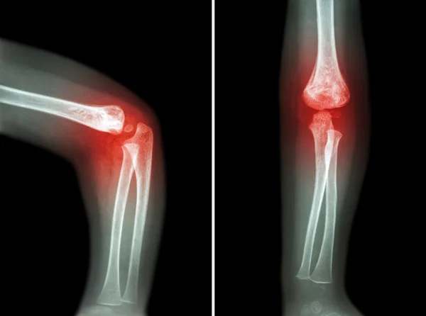 Artritis reumatoide, Artritis gotosa (radiografía de la película del codo del niño con artritis en el codo) (Vista lateral y frontal, lateral y anterior - Vista posterior) (2 posiciones  ) — Foto de Stock