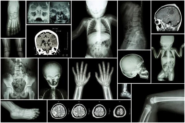 X-ray multiple part of child 's body & multiple disease ( stroke , brain tumor , rheumatoid arthritis , sinusitis , gouty arthritis , etc)( skull chest lung heart spine arm hand pelvis leg knee foot ) — ストック写真