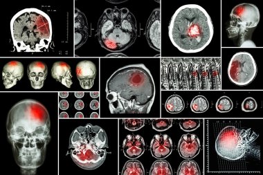 Set , Beyin hastalığı toplama ( Serebral enfarktüs , Hemorajik inme , Beyin tümörü , omurilik kompresyonu ile disk hernisi ,vb)( Ct taraması , Mri , Mrt )( Nöroloji ve Sinir sistemi )
