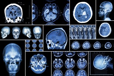 Set , Beyin hastalığı toplama ( Serebral enfarktüs , Hemorajik inme , Beyin tümörü , omurilik kompresyonu ile disk hernisi ,vb)( Ct taraması , Mri , Mrt )( Nöroloji ve Sinir sistemi )