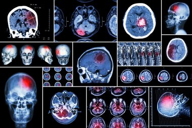 Set , Collection of brain disease ( Cerebral infarction , Hemorrhagic stroke , Brain tumor , Disc herniation with spinal cord compression ,etc)( CT scan , MRI , MRT )( Neurology and Nervous system ) clipart
