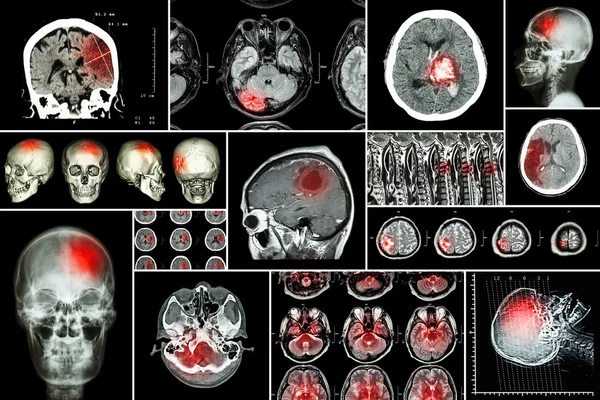 Conjunto, coleção de doença cerebral (infarto cerebral, acidente vascular cerebral hemorrágico, tumor cerebral, hérnia de disco com compressão da medula espinhal, etc) (tomografia computadorizada, ressonância magnética, MRT) (Neurologia e sistema nervoso  ) — Fotografia de Stock