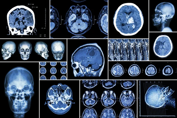 Set , Collection of brain disease ( Cerebral infarction , Hemorrhagic stroke , Brain tumor , Disc herniation with spinal cord compression ,etc)( CT scan , MRI , MRT )( Neurology and Nervous system ) — Stock Photo, Image