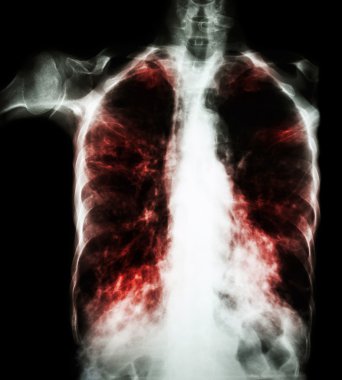 Pulmonary Tuberculosis  ( film chest x-ray :  interstitial infiltrate both lung due to Mycobacterium tuberculosis infection ) clipart