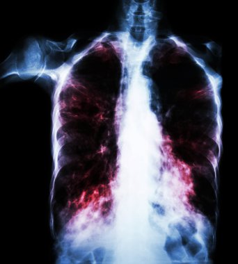 Pulmoner Tüberküloz ( film göğüs röntgeni : Mycobacterium tuberculosis enfeksiyonuna bağlı olarak her iki akciğere de infiltrasyon )