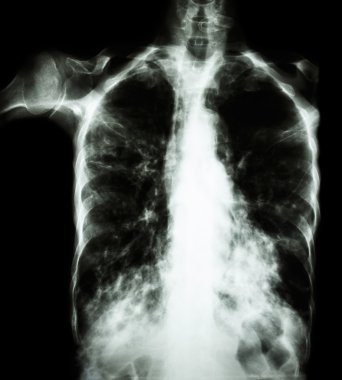 Pulmoner Tüberküloz ( film göğüs röntgeni : Mycobacterium tuberculosis enfeksiyonuna bağlı olarak her iki akciğere de infiltrasyon )