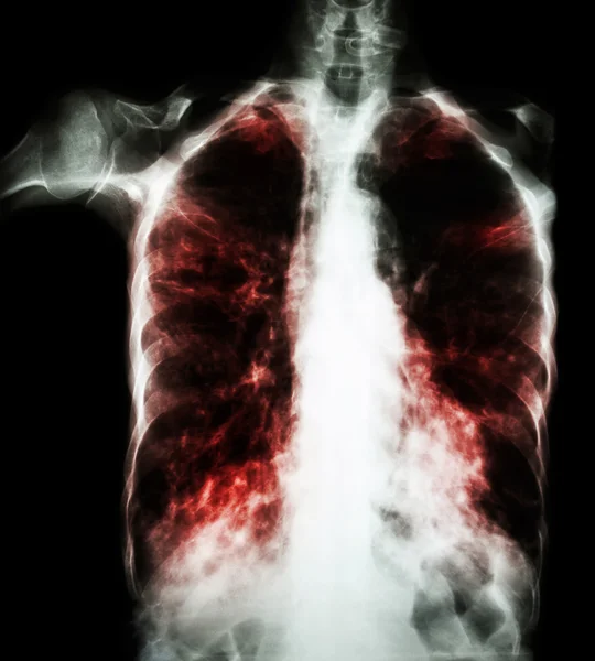 Pulmonary Tuberculosis  ( film chest x-ray :  interstitial infiltrate both lung due to Mycobacterium tuberculosis infection ) — Stock Photo, Image