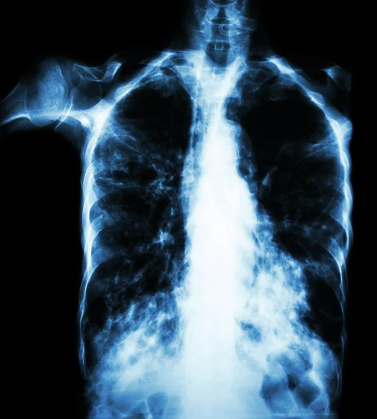 肺结核（薄膜胸部X射线：由于结核分枝杆菌感染而间隙渗透两肺 ) — 图库照片