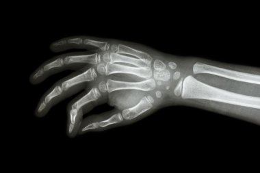 Çocuğun film x-ray eli ( eğik görünümü )