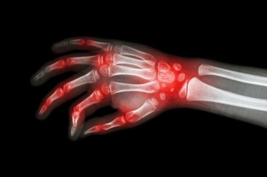 Rheumatoid arthritis , Gouty arthritis ( Film x-ray hand of child with arthritis at multiple joint ) clipart