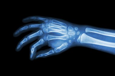 Çocuğun film x-ray eli ( eğik görünümü )