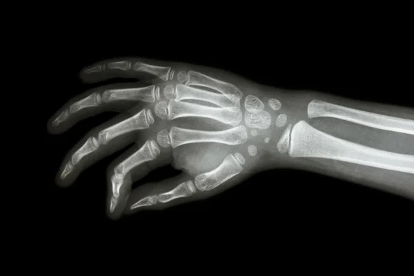 Film x-ray hand van kind (schuin zicht ) — Stockfoto