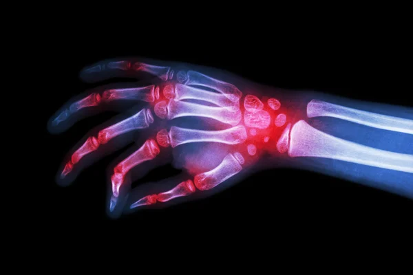Reumatoidalne zapalenie stawów, dnawego zapalenia stawów (film x-ray ręka dziecka z zapaleniem stawów w wielu stawów ) — Zdjęcie stockowe