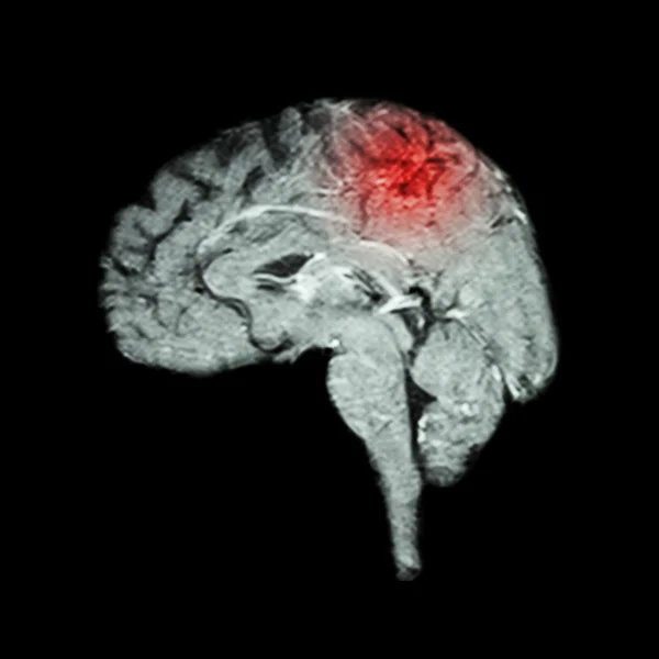 Imagem por Ressonância Magnética (RM) do cérebro e do acidente vascular cerebral (conceito médico, científico e de saúde)  ) — Fotografia de Stock